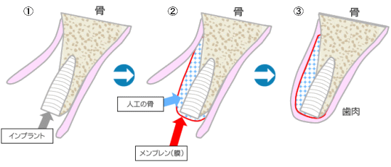 GBR治療方法