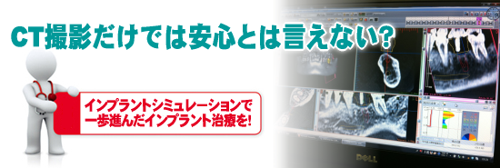インプラント術前シミュレーション